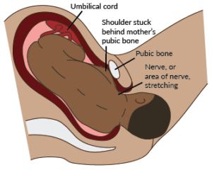 Cartoon drawing of a cross-section of a baby being born but their shoulder is stuck behind the mother's pubic bone cause stretching to the nerve